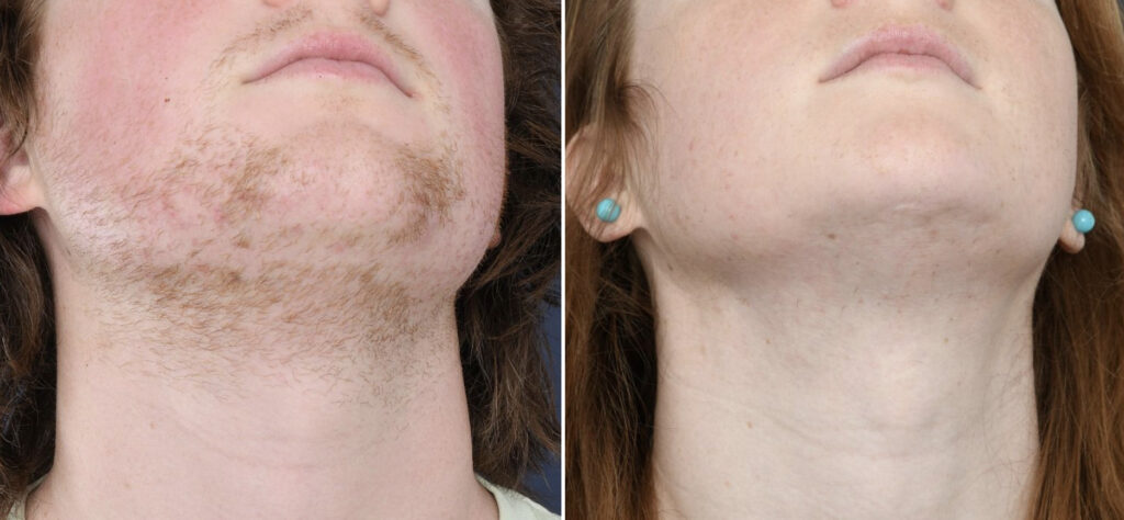 Electrolysis results on the chin, cheeks and neck