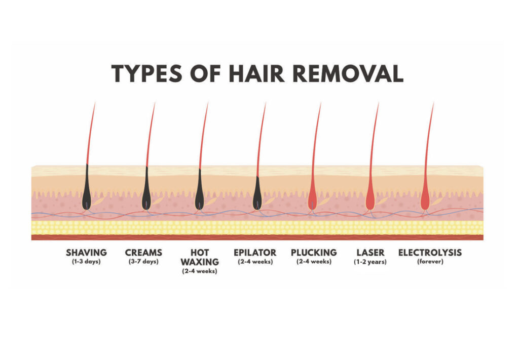 Methods of hair removal, shaving, creams, hot waxing, epilator, plucking, laser and electrolysis and the length of time the hair is removed.