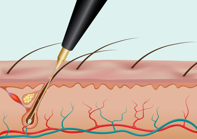 Illustration of an electrolysis instrument for permanent hair removal service.